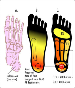 Image of Plantar Fasciitis areas with thanks to Wikipedia